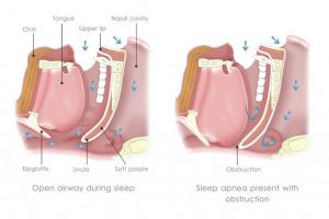 what-causes-snoring