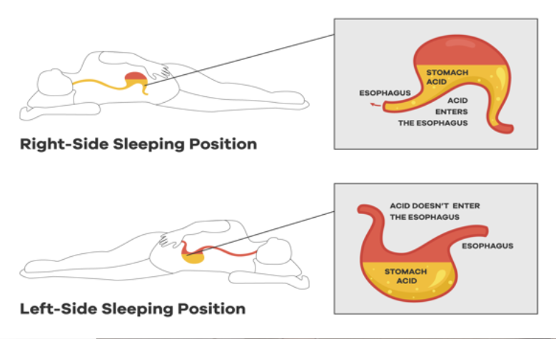 4-tips-how-to-improve-your-sleep-when-you-have-gerd-updated-2024