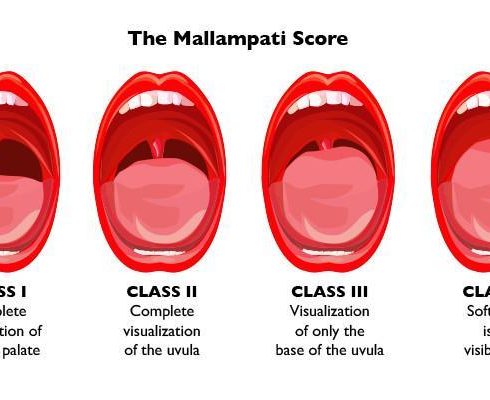 What Is Obstructive Sleep Apnea? Mallampati Score And Predicting Sleep Apnea