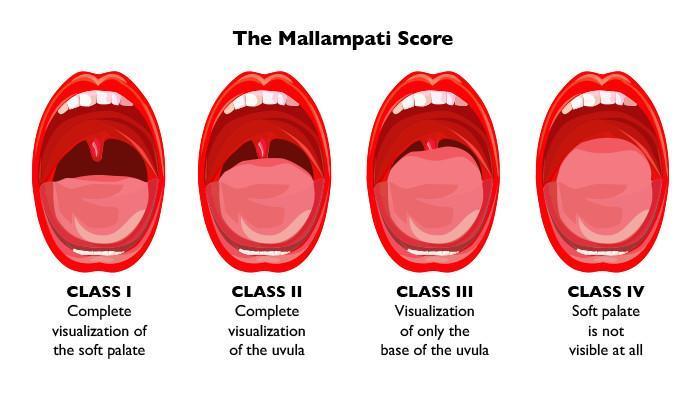 mallampati-score-and-predicting-sleep-apnea-1.jpg