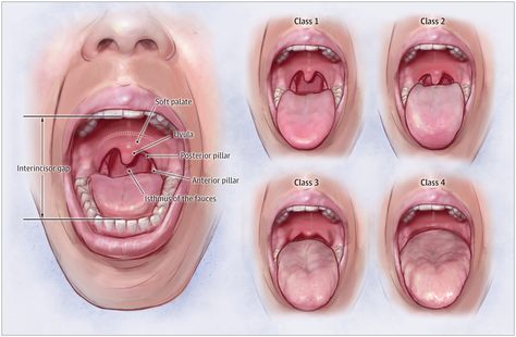 mallampati-score-and-predicting-sleep-apnea-3.png