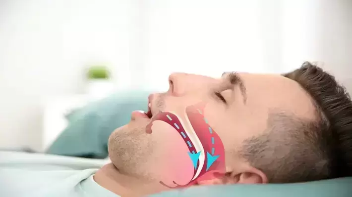 micrognathia-and-obstructive-sleep-apnea-1.webp