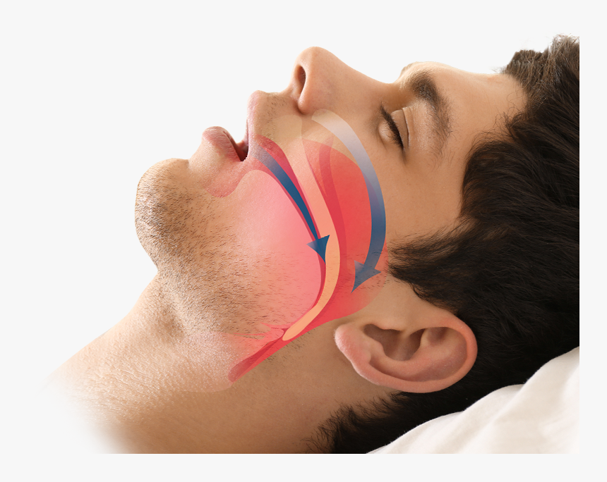 micrognathia-and-obstructive-sleep-apnea-2.png