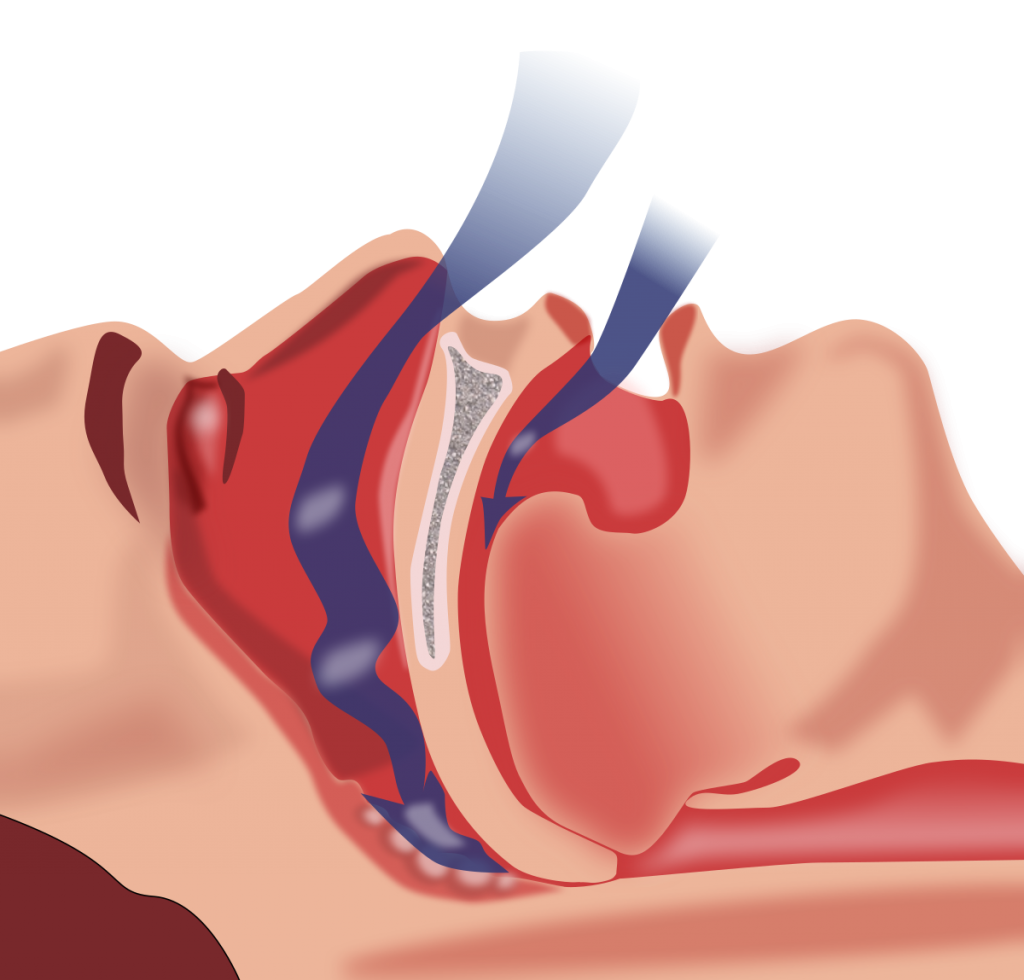micrognathia-and-obstructive-sleep-apnea.png