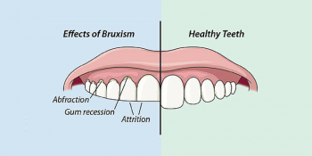 What is Bruxism? 3 Tips For Coping With Bruxism Or Teeth Grinding