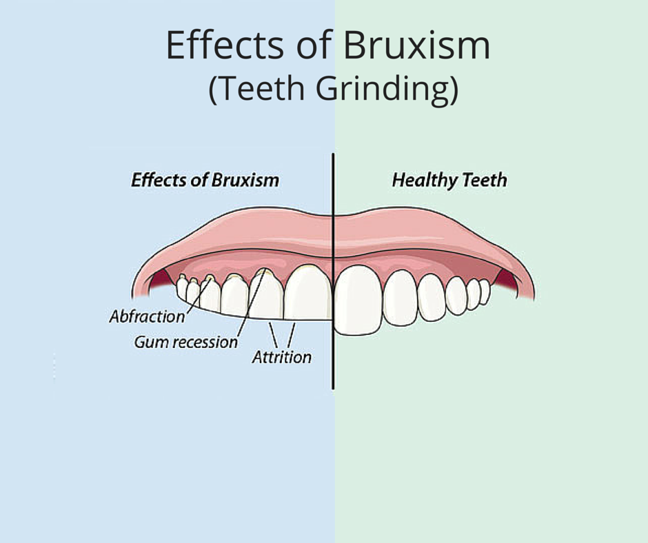 dentist in palarivattom : Teeth Grinding or Effects Of Bruxism